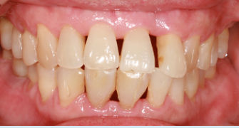 retractie-gingivala